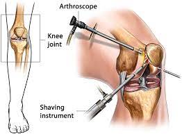 Arthroscopy and Joint Replacement        